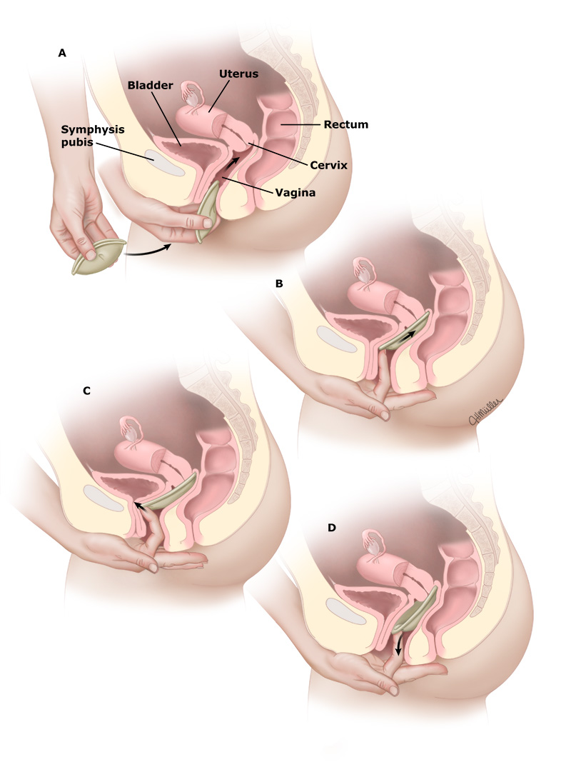 pussy insertions Extreme