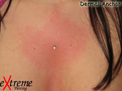 Dermal anchor brust